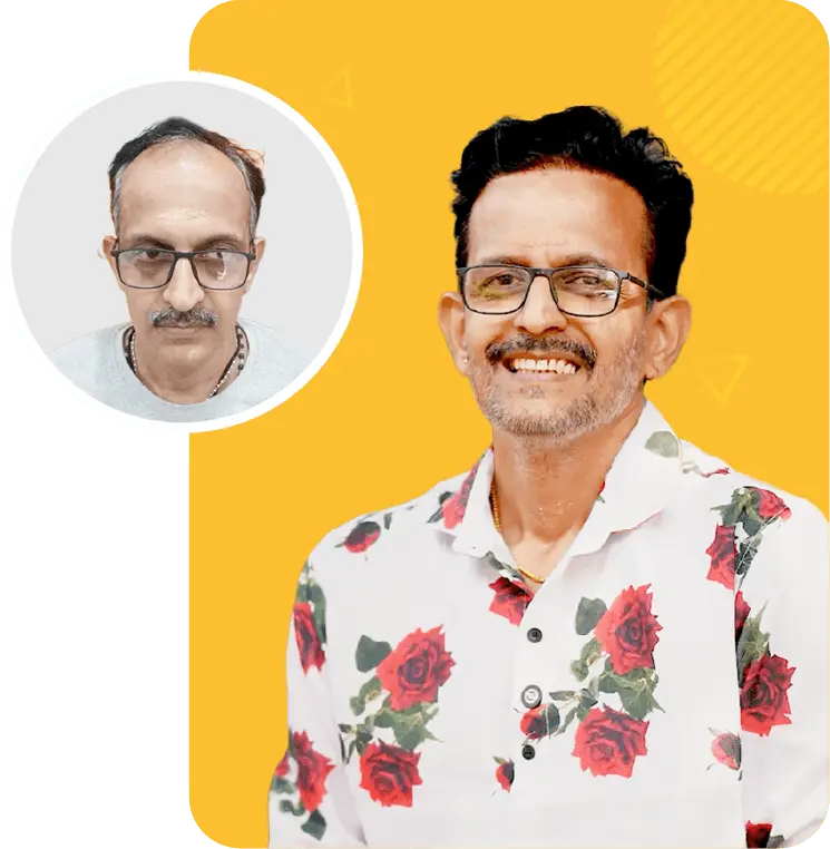 Best hair transplant in Kochi