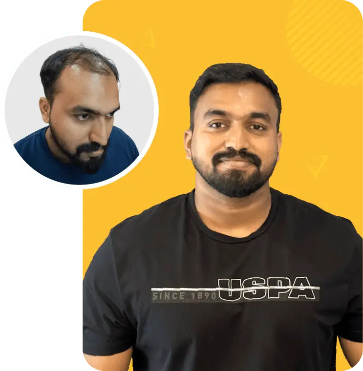Best hair transplant in Kochi