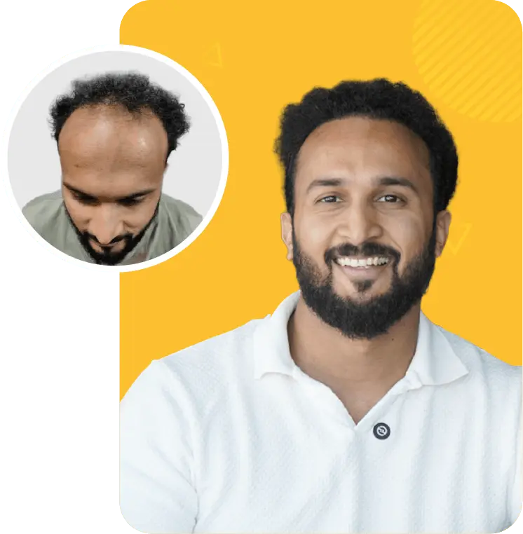 Best hair transplant in Kochi