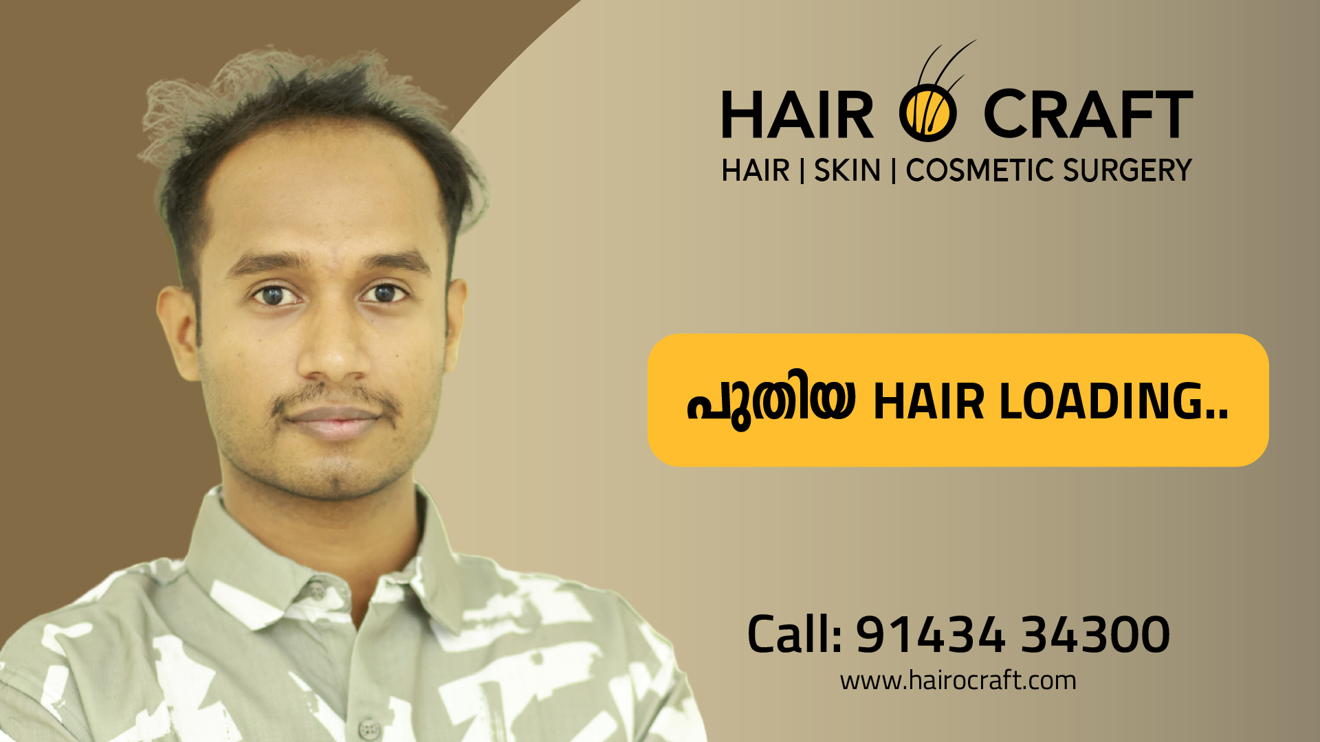 Before-and-after hair transplant transformation at Hair O Craft, featuring a client with restored hair growth, enhanced hairline, and successful natural-looking results.