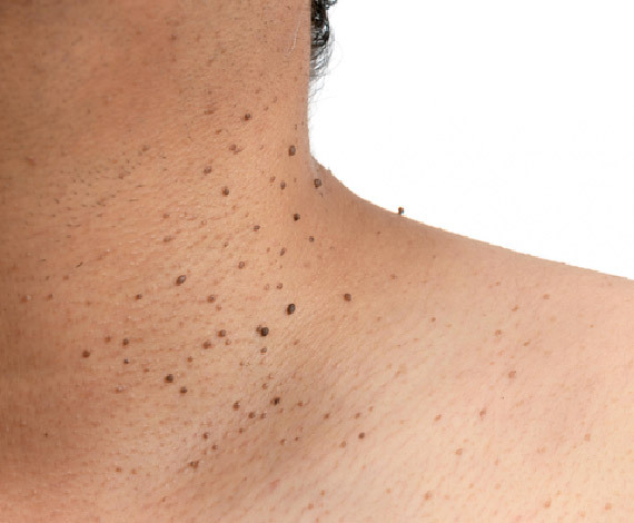 What is Warts & Skin Tag Removal?