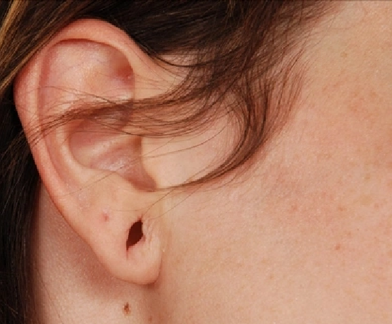 Reasons for Earlobe Repair