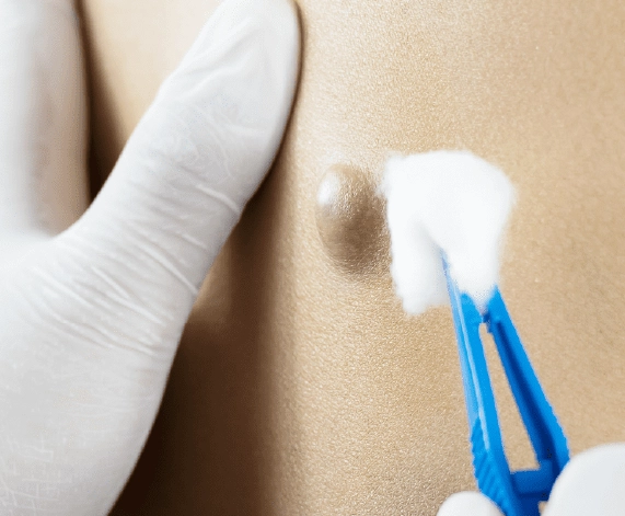 Safe and Scar-Minimizing Cyst Removal by Experts 