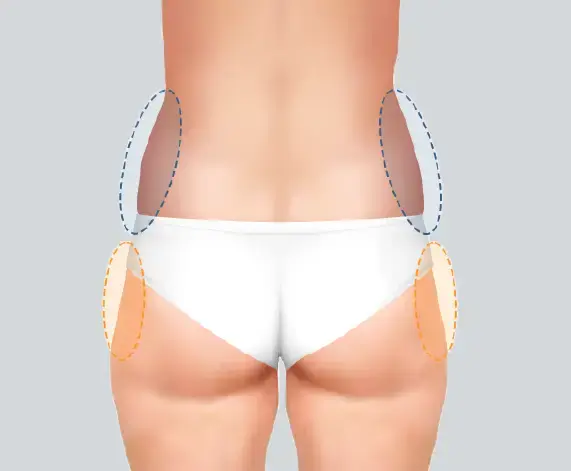 Reasons for Hip Dip Correction