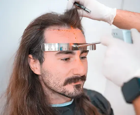 Long Hair Transplant