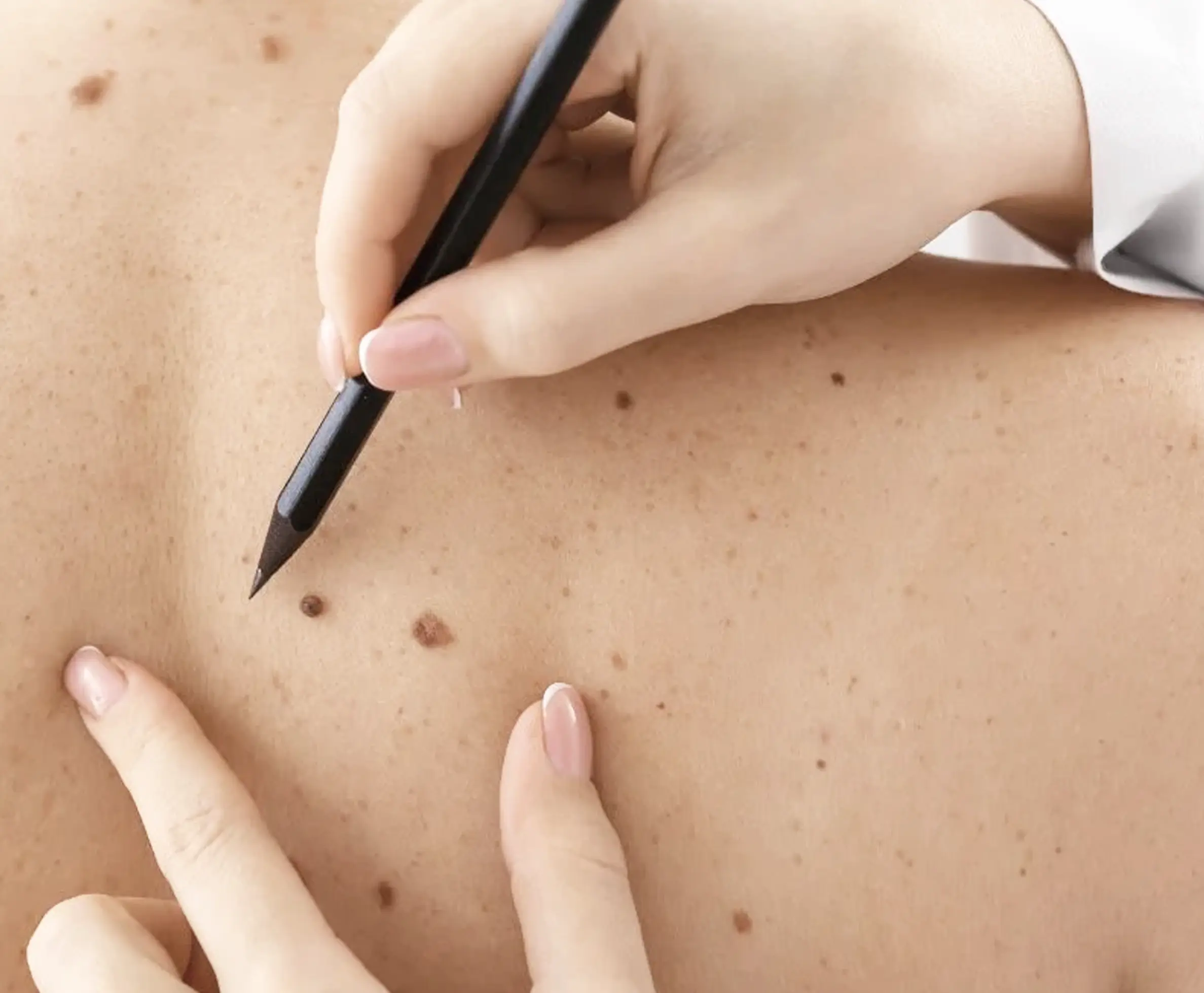 Warts & Skin Tag Removal in Kochi, Kozhikode, Bangalore, Thiruvananthapuram & Chennai