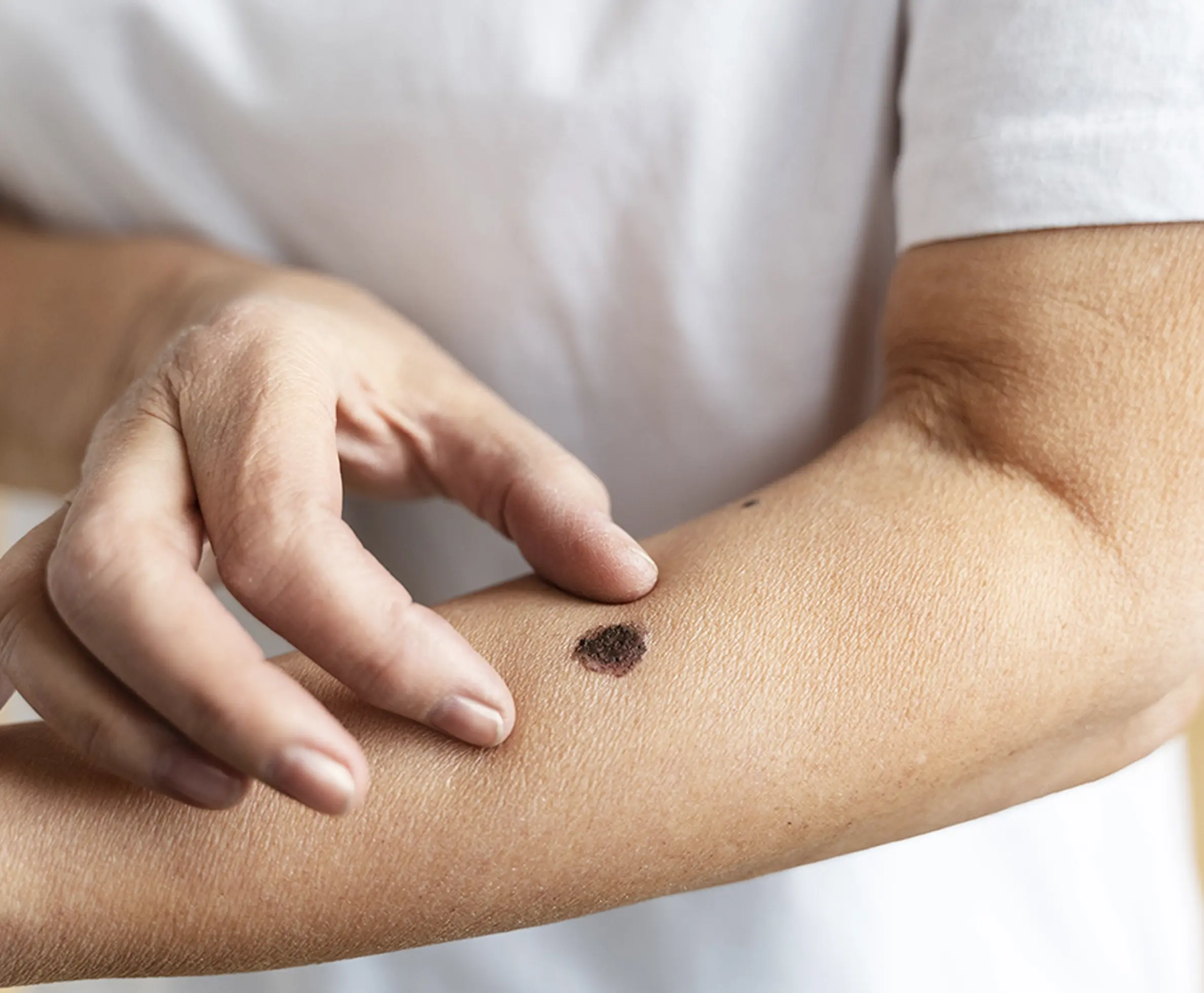 Mole Removal in Kochi, Kozhikode, Bangalore, Thrissur, Kannur, Thiruvalla, Thiruvananthapuram & Chennai