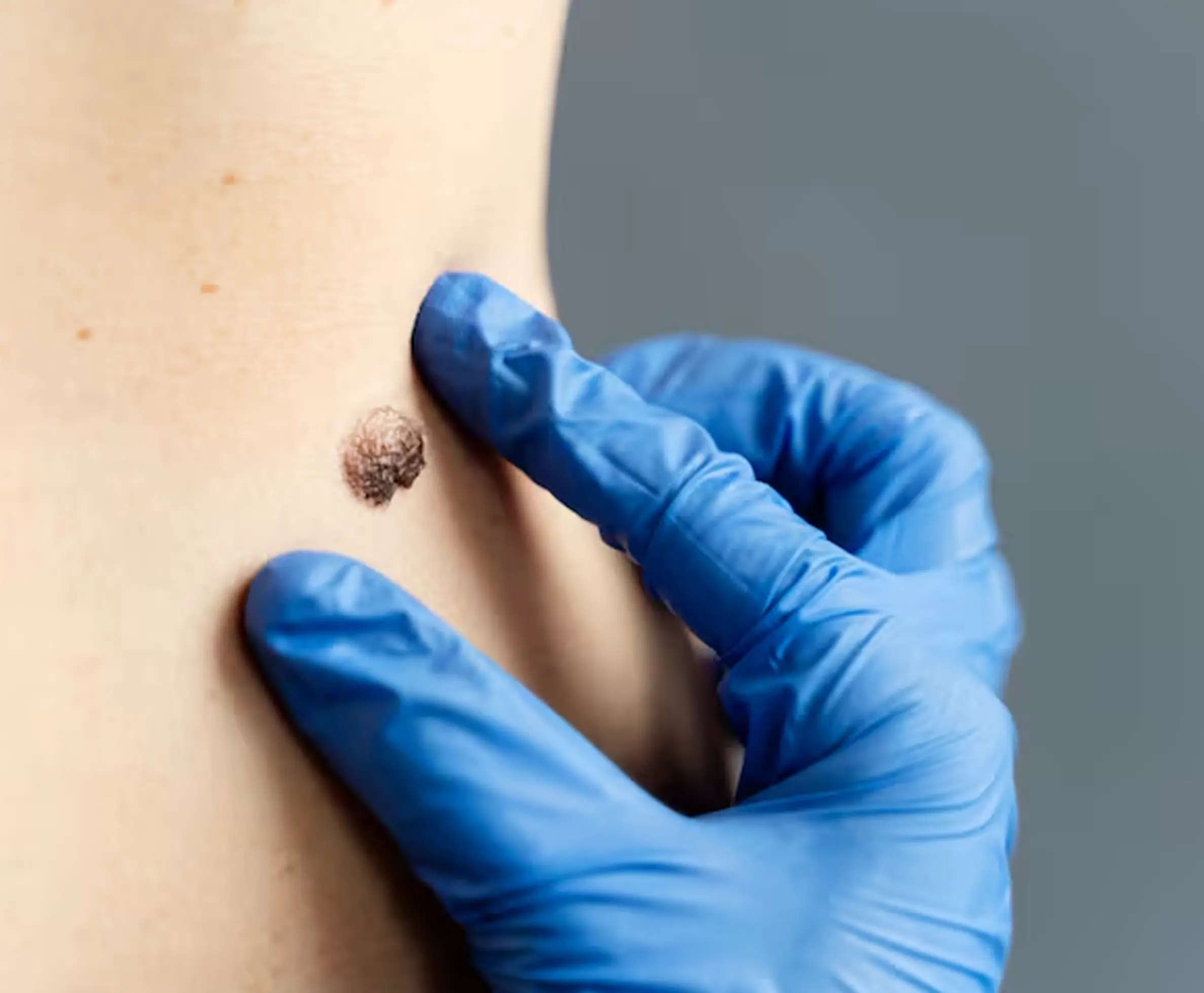 Why to Choose Mole Removal Treatment?